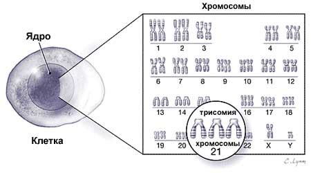 Особенности генетического аппарата при синдроме Дауна