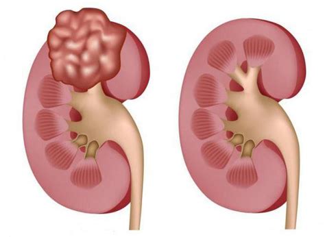 Особенности доброкачественной опухоли почки