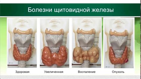 Особенности лечения повышенного давления при проблемах со щитовидной железой у беременных женщин