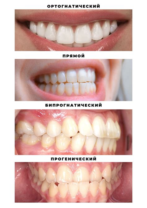 Особенности накладных клыков для разных типов зубов и прикуса