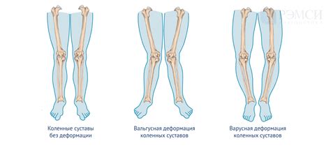 Особенности формирования коленных чашечек