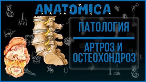 Остеоартрит и артроз