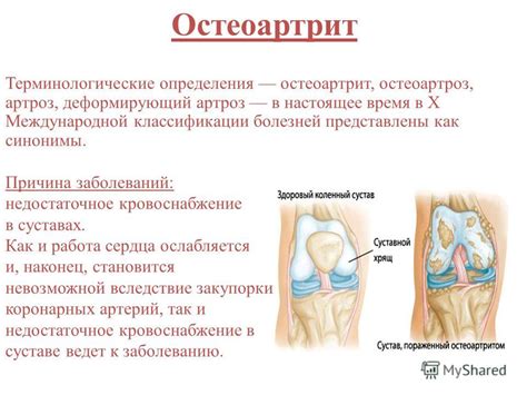 Остеоартрит как основная причина боли