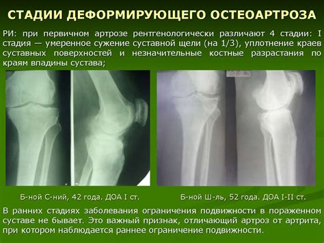 Остеоартроз и деформация суставов