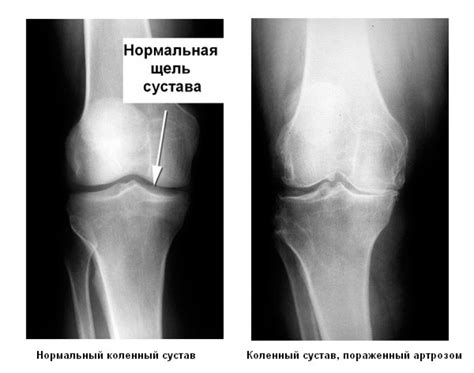 Остеоартроз и его влияние на колени