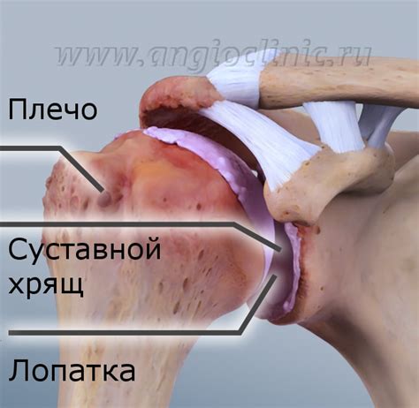 Остеоартроз плечевого сустава