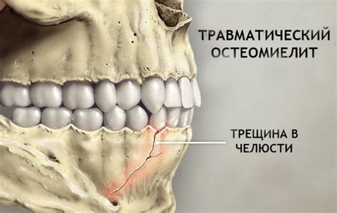 Остеомиелит: симптомы и причины развития