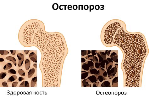 Остеопороз