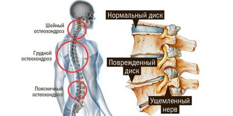 Остеохондроз поясничного отдела позвоночника