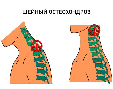 Остеохондроз шейного отдела позвоночника: