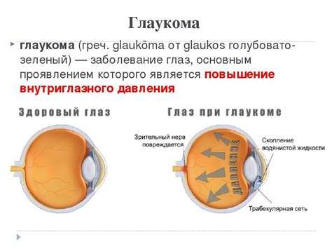 Острое глаукоматозное приступы