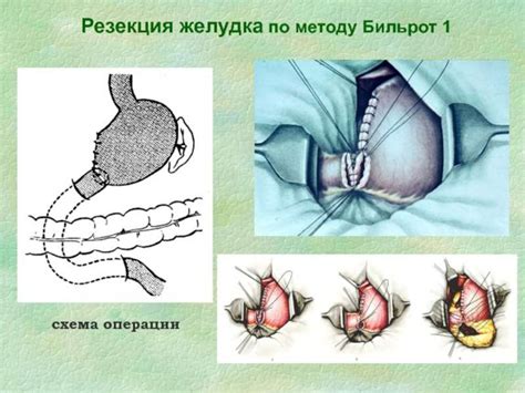 Острое кровотечение