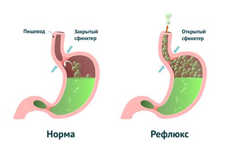 Остро выпущенные газы из желудка