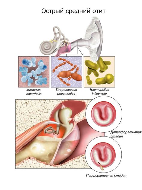 Острый и хронический средний отит