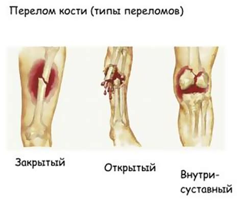 Отличительные признаки ушиба носа от перелома