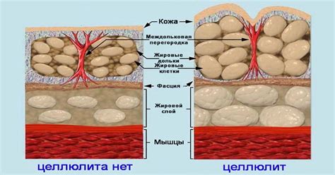 Отложения жира в тканях и образование целлюлита