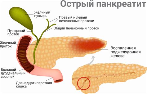 Панкреатит: основные признаки и лечение