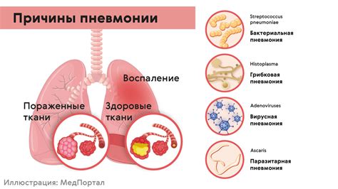 Патологии легких: бронхит, астма, пневмония