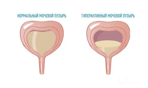 Патологии мочевого пузыря