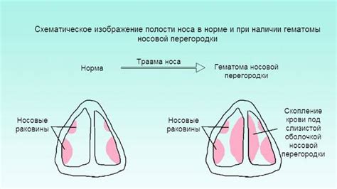 Патологии носовой перегородки