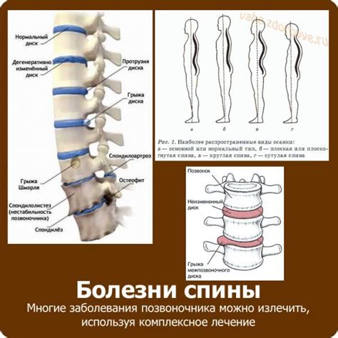 Патологии позвоночника и их последствия для организма