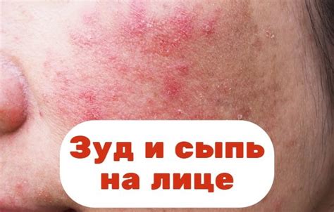 Первая помощь при сильном зуде на лице