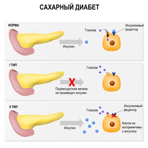 Первичные причины судорог при сахарном диабете