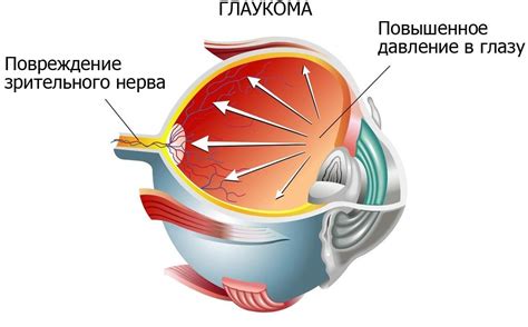 Первые признаки катаракты глаза