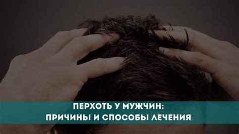 Перхоть у мужчин: 5 эффективных способов дома