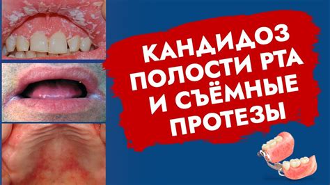 Пищевые нарушения и кровоизлияние в полости рта: что стоит знать?