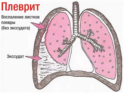 Плеврит и легочные заболевания