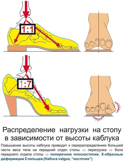 Плоскостопие: эффект на форму ног