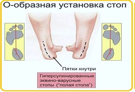 Плоскостопие и высокий свод: как аномалии стопы влияют на здоровье ног?