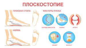 Плоскостопие - основная причина болевых ощущений