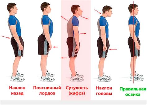 Плохая осанка и неправильная походка