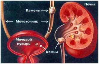 Побочные эффекты и осложнения при наличии мочевого камня