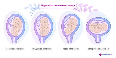 Поворот ребенка в головное вниз положение