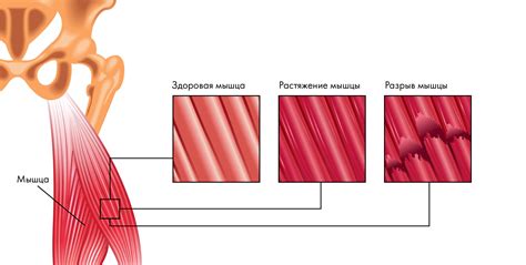 Повреждение мышц и связок в области тазового дна