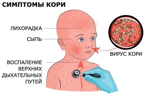 Повторное заболевание ветрянкой: причины и факторы риска