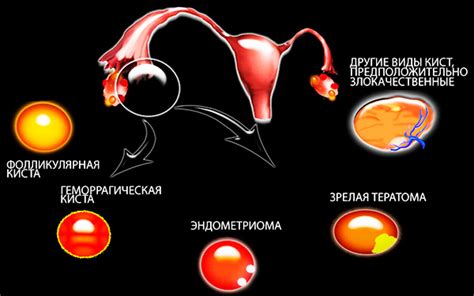 Повышение ХГЧ при кисте яичников