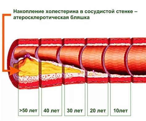 Повышение вероятности образования холестериновых отложений