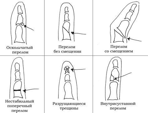 Повышенная вероятность переломов пальцев