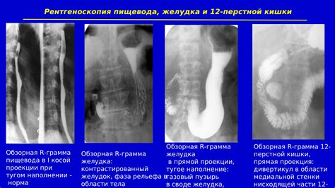 Повышенная стереотипность пищевода