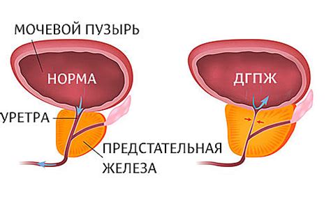 Повышенный риск простатита