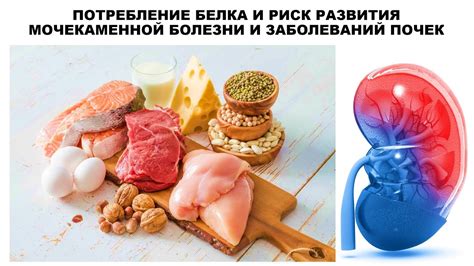 Повышенный риск развития мочекаменной болезни