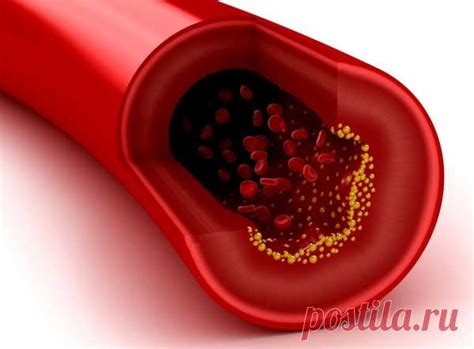 Повышенный холестерин в крови