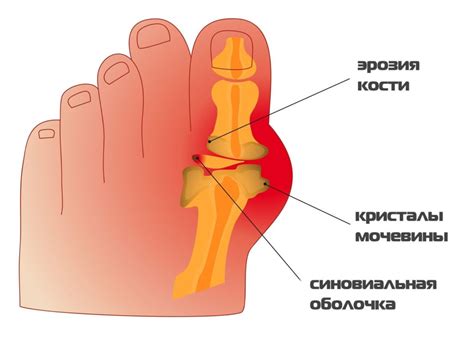 Подагра и арахноида: