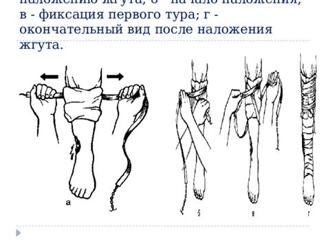 Подготовка к снятию жгута