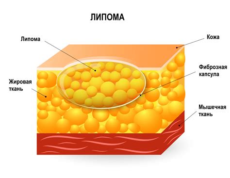 Подкожный жировик: что это?