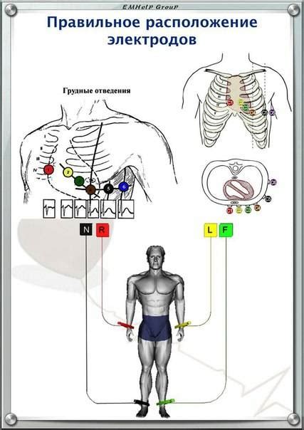 Позиционирование электродов и подключение кардиографа